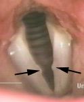 vocal fold nodules