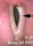 paralysis of vocal folds