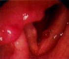 gastric reflux on vocal folds