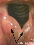 reinkes edema of vocal fold