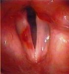 haemorrage of the vocal fold