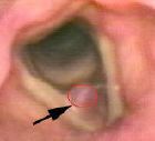 a vocal fold polyp